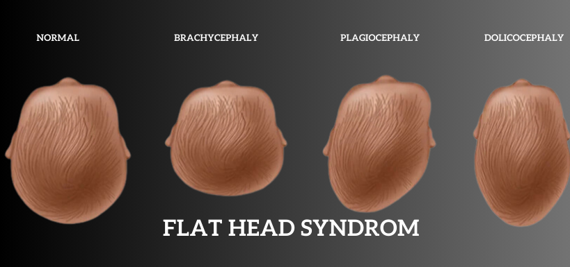 Flat Head Syndrome